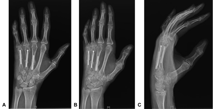 Corrective Metacarpal Osteotomy with Intramedullary Screw Fixation: Technique and Case Report