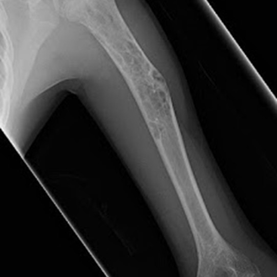 A historical asymptomatic population revealed an 18.9% prevalence of benign childhood bone tumors of the extremities, according to results. Christopher D. Collier, MD, and colleagues reviewed a historical, longitudinal radiographic collection of healthy children that included comprehensive, left-sided radiographs of the extremities at yearly intervals. A multidisciplinary panel reviewed all potential tumors and confirmed the radiographic diagnosis of each lesion, the age at which the lesion first appeared and the age at which it had resolved. Researchers calculated prevalence rates using the number of distinct patients available for each radiographic location and age. Read more. Source: https://www.healio.com/news/orthopedics/20210315/asymptomatic-children-had-a-189-prevalence-of-benign-bone-tumors